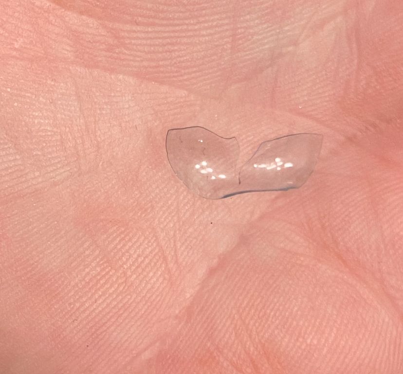 Two quarters of a clear contact lens barely held together at the outer edge is on the palm  of a hand that looks very dry.

Where is the other half? That is a good question! I wish I had the answer