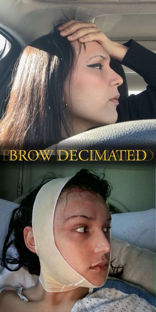 brow comparison pre ffs > 16 hours post ffs