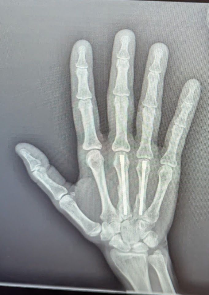X-ray of my right hand. You can still kind of see where the fractures were, but they are smooth and healed. There are enormous screws through the bones in the middle of the hand that connect to the middle and ring fingers. The screws run basically the length of those two bones.