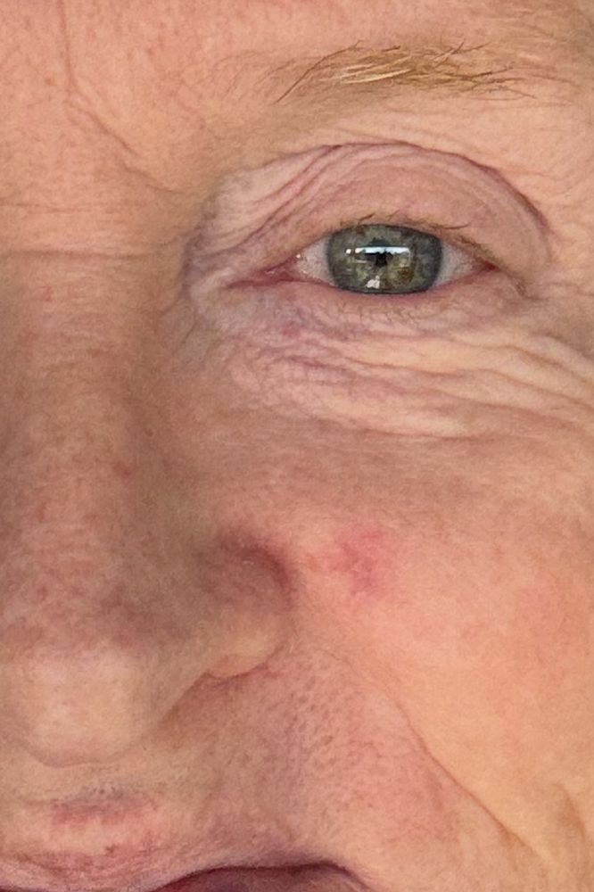 BEFORE - a close up of a face showing a small skin blemish near the nose.