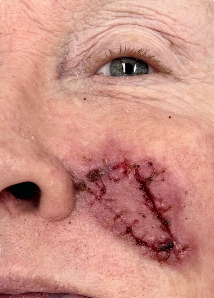 AFTER - a close-up of a face showing a large triangular-shaped scar and after stitches were removed following surgery to remove a basal cell carcinoma.