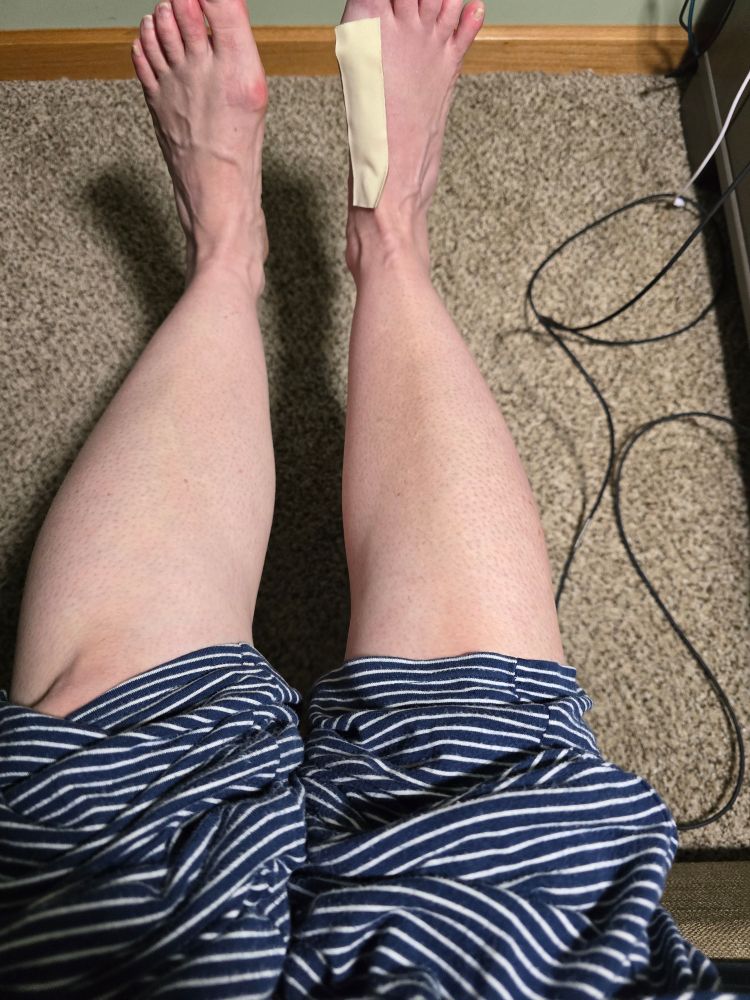 A picture of legs from the knee to ankles with the right calf noticeably smaller than the left.
