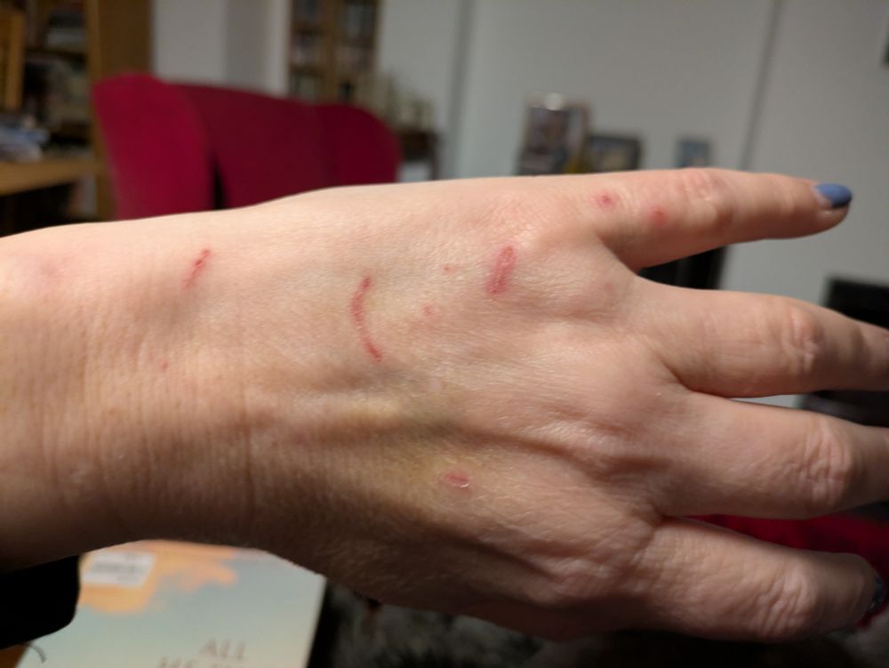 Hand covered with cat scratches