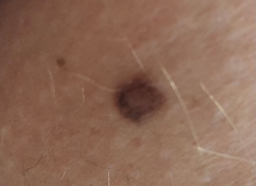 Brown mole on skin. 