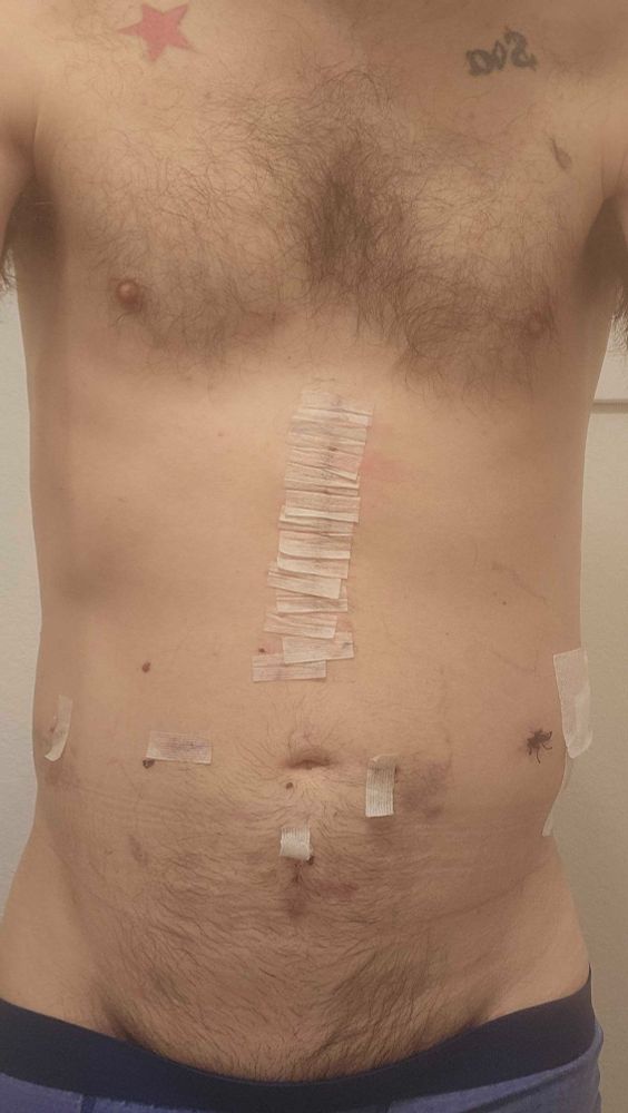 photo a few days later of the surgical area--some punctures where the robot assisted 