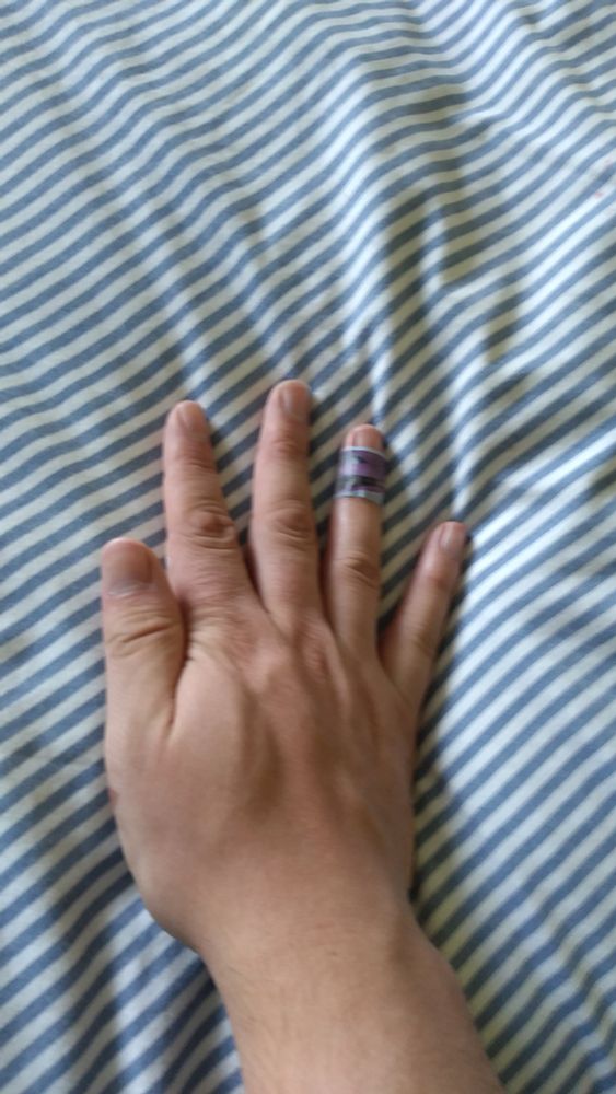 Right hand with another injured finger (glass cut) and a burn on the lower part of my thumb.