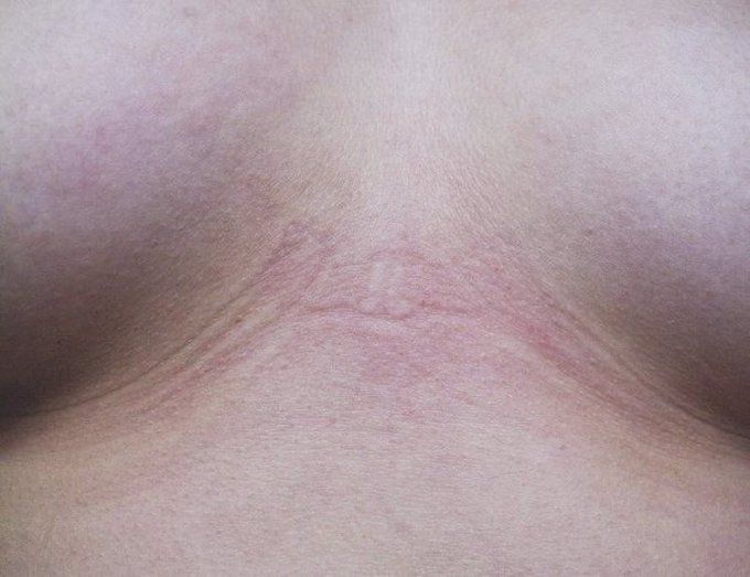 Close up image of the skin between two breasts where a wired bra has left an imprint