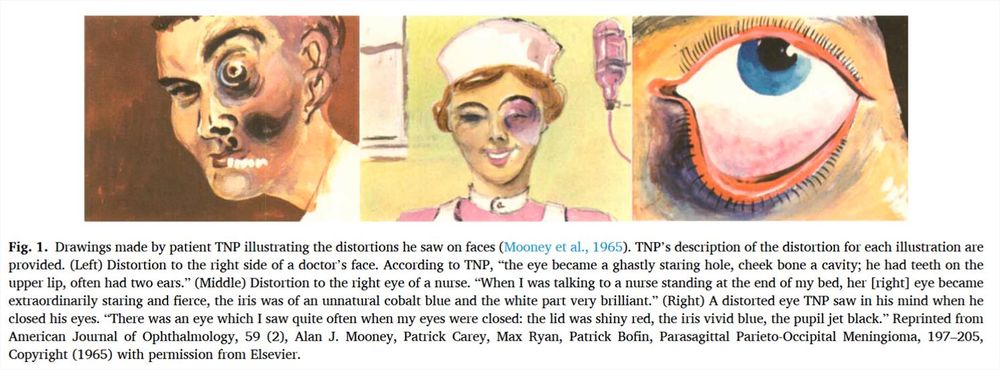 Drawings made by patient TNP illustrating the distortions he saw on faces (Mooney et al., 1965). TNP’s description of the distortion for each illustration are
provided. (Left) Distortion to the right side of a doctor’s face. According to TNP, “the eye became a ghastly staring hole, cheek bone a cavity; he had teeth on the
upper lip, often had two ears.” (Middle) Distortion to the right eye of a nurse. “When I was talking to a nurse standing at the end of my bed, her [right] eye became
extraordinarily staring and fierce, the iris was of an unnatural cobalt blue and the white part very brilliant.” (Right) A distorted eye TNP saw in his mind when he
closed his eyes. “There was an eye which I saw quite often when my eyes were closed: the lid was shiny red, the iris vivid blue, the pupil jet black.” 