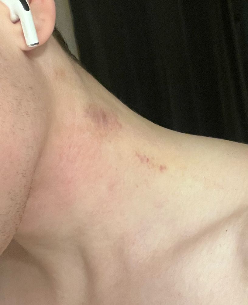 The picture has a white trans man zoomed into  the right side of his neck, showcasing hickies and bruises.