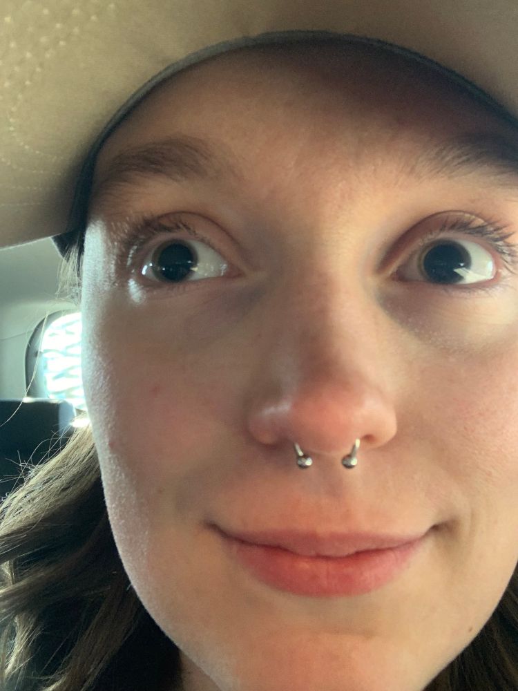 A person with very dilated pupils 