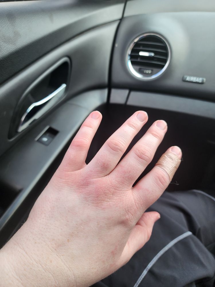 A close-up of a left hand with red and swollen skin, particularly around the knuckles. 