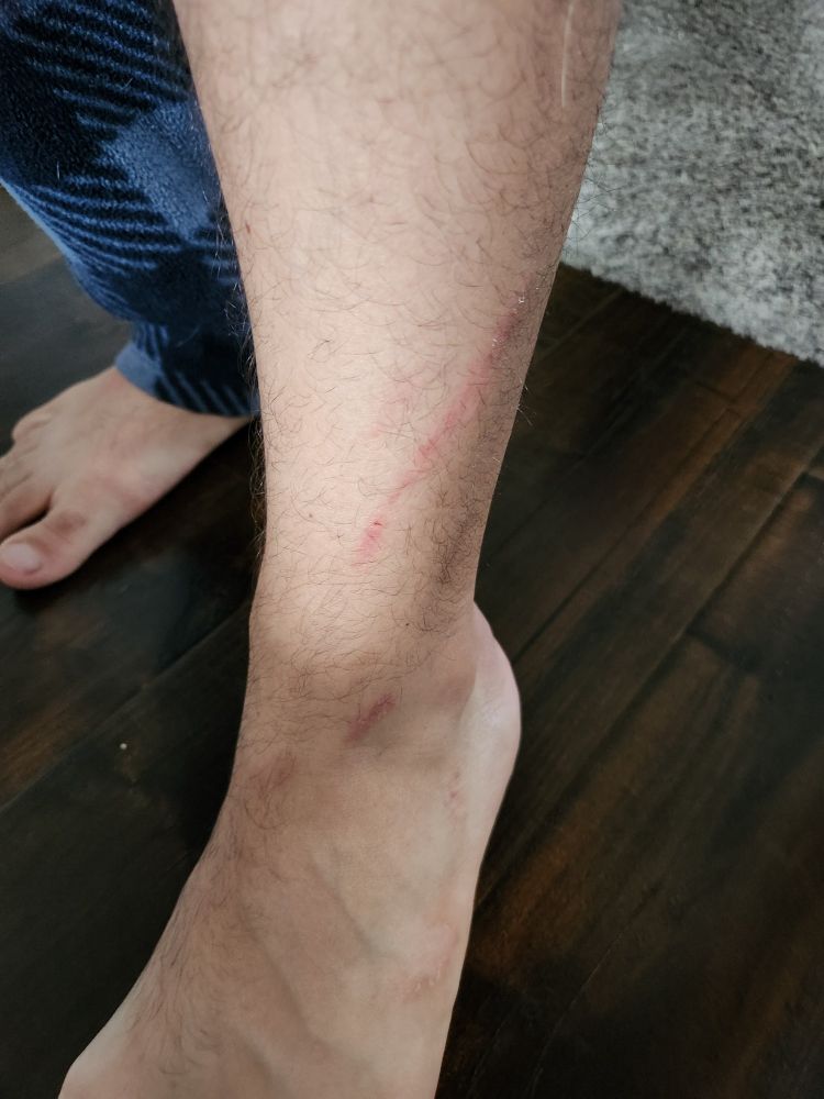 Photo of a leg with a wound caused by a terrible player 