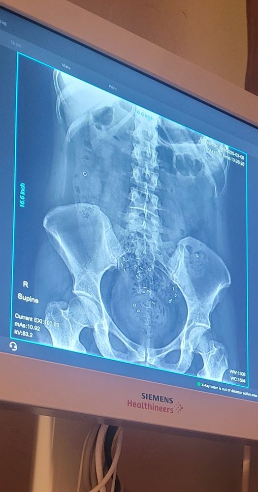 An x ray image of the abdomen, with small rings scattered throughout the intestinal track (part of a test)