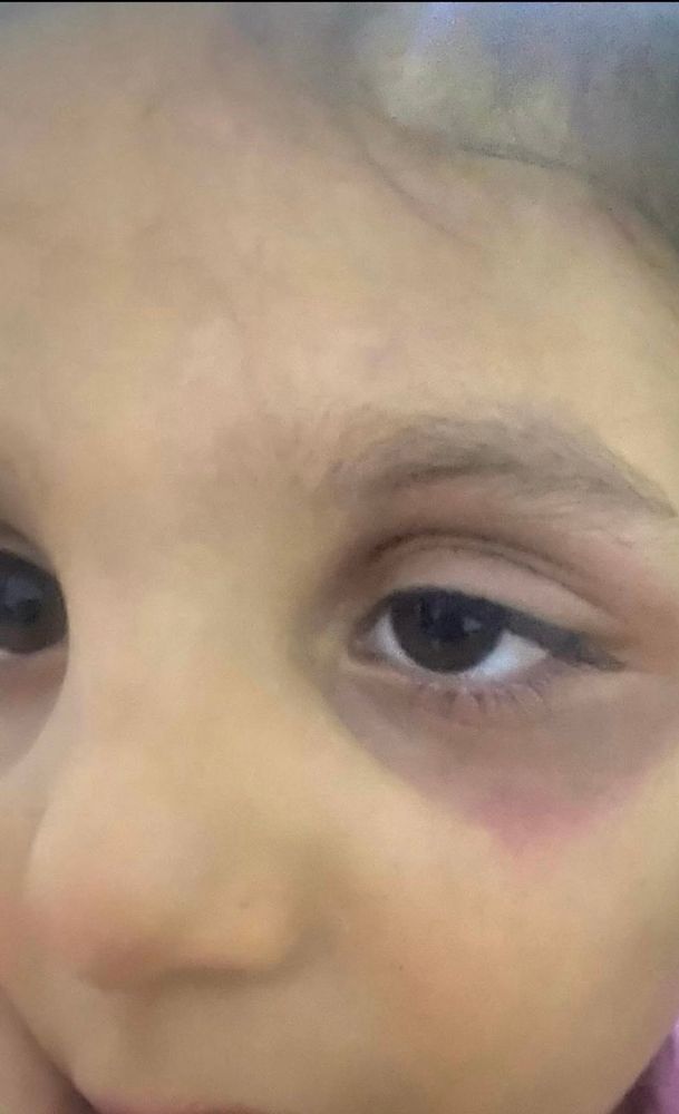 The picture of a pretty little girl, who is very malnourished, and has a swollen and discolored eye.