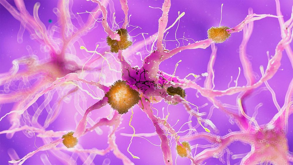 Highly Anticipated Alzheimer's Trials Yield Disappointing Results for GLP-1 Drug