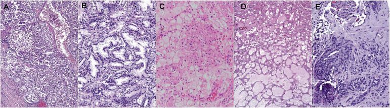 Renal Cell Carcinoma Subtypes Based on Histology. (A) Clear cell renal cell carcinoma. (B) Papillary renal cell carcinoma. (C) Chromophobe renal cell carcinoma. (D) Oncocytoma. (E) Medullary renal cell carcinoma. Based on information in Williamson SR. Renal cell carcinoma classification: what matters? Diagn Histopathol. 2022;28(6):301-308. doi:10.1016/j.mpdhp.2022.03.004; and Garje R, Elhag D, Yasin HA, Acharya L, Vaena D, Dahmoush L. Comprehensive review of chromophobe renal cell carcinoma. Crit Rev Oncol Hematol. 2021:160:103287. doi:10.1016/j.critrevonc.2021.103287