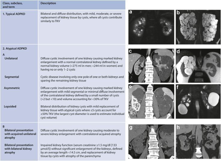  The Mayo Imaging Classification of ADPKD description (left panel) and imaging examples (right panel) with examples (right panel) of (a, b) subclass 1A and 1E, (c-f) subclass 2A, and (g, h) subclass 2B. Abbreviations: ADPKD, autosomal dominant polycystic kidney disease; TKV, total kidney volume. Reproduced with permission of the copyright holder (Kidney Disease: Improving Global Outcomes) from Kidney Disease: Improving Global Outcomes (KDIGO) ADPKD Work Group. KDIGO 2025 Clinical Practice Guideline for the Evaluation, Management, and Treatment of Autosomal Dominant Polycystic Kidney Disease (ADPKD). Kidney Int. 2025;107(suppl 2S):S1-S239. doi:10.1016/j.kint.2024.07.009