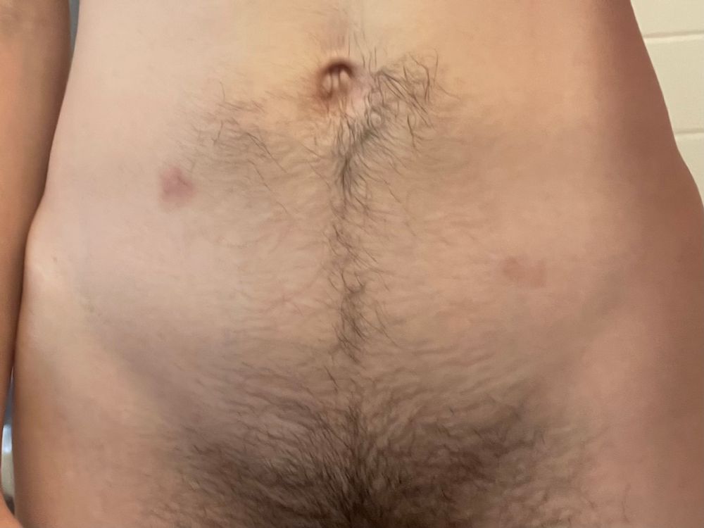 closeup of Wren's lower stomach, with two purple hickeys visible below their belly button
