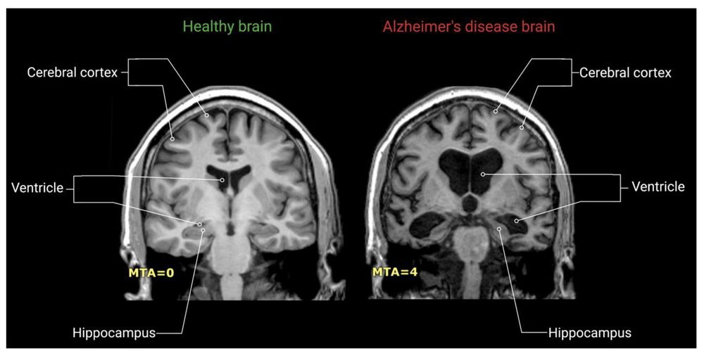 MRI comparison, normal brain vs. Alzheimers