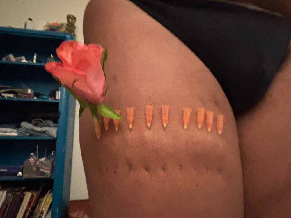 Sonya’s thigh with ten needles in a line with a rose in the left most needle 