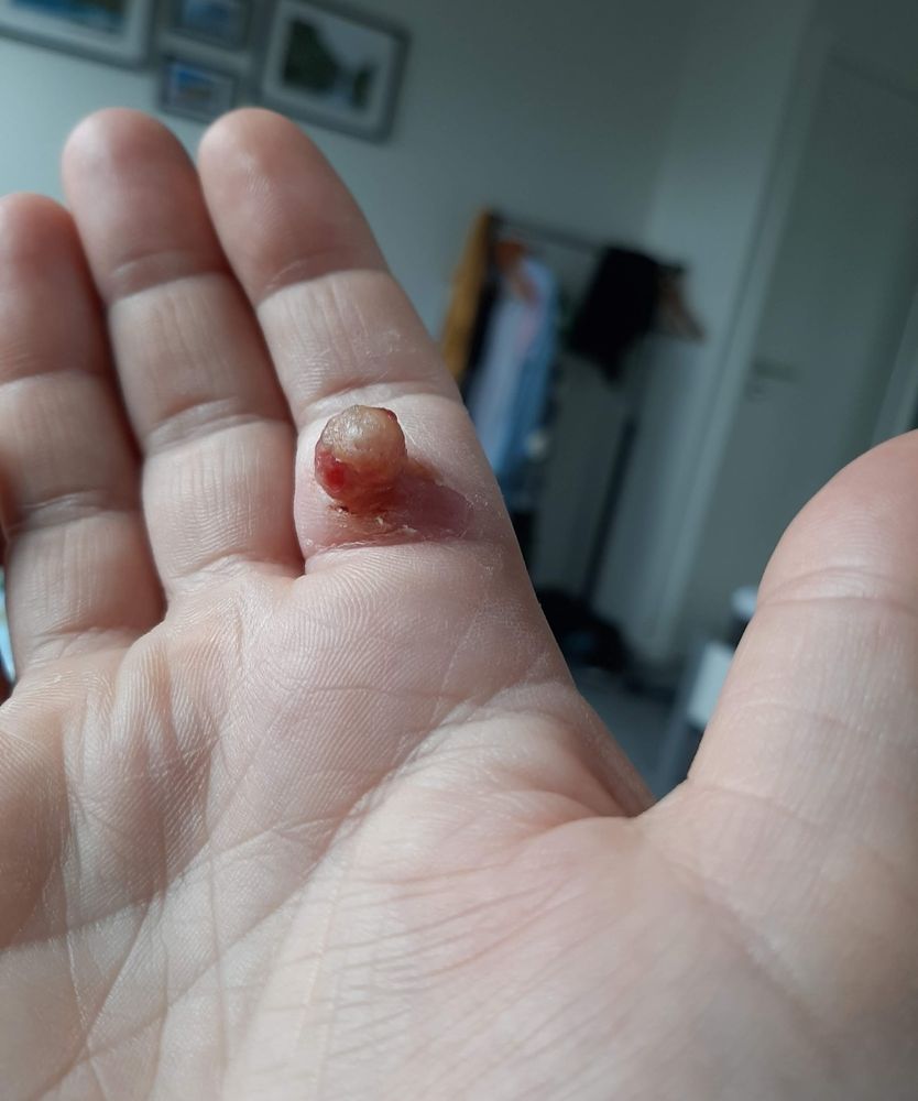 Höger hand med en äcklig liten tumör på insidan av pekfingret. Tumören ser ut som en röd sårig ärta.