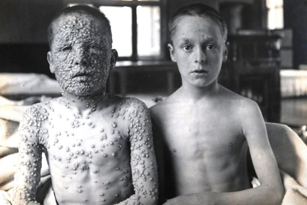 A black and white photo of two young boys. One is covered in the tell-tale pustules of smallpox while the other boy is not. This photo is courtesy of the Dr. Jenner House Museum. 