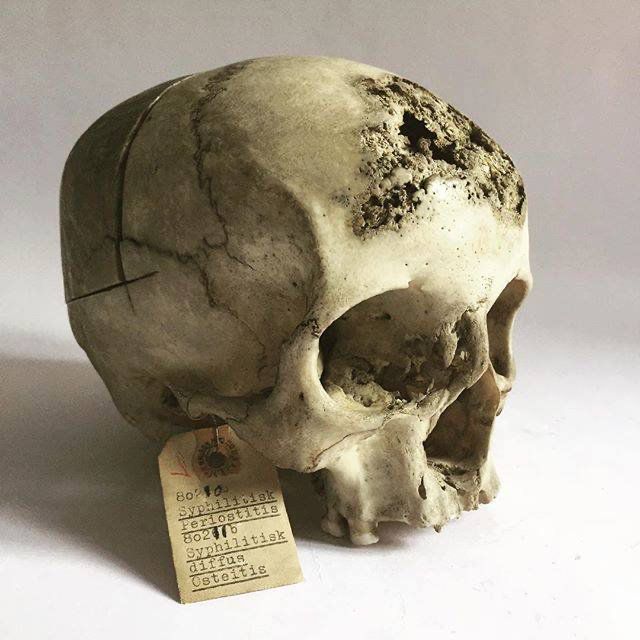 A skull showing severe pitting in the front. There is also a tag on the skull. 