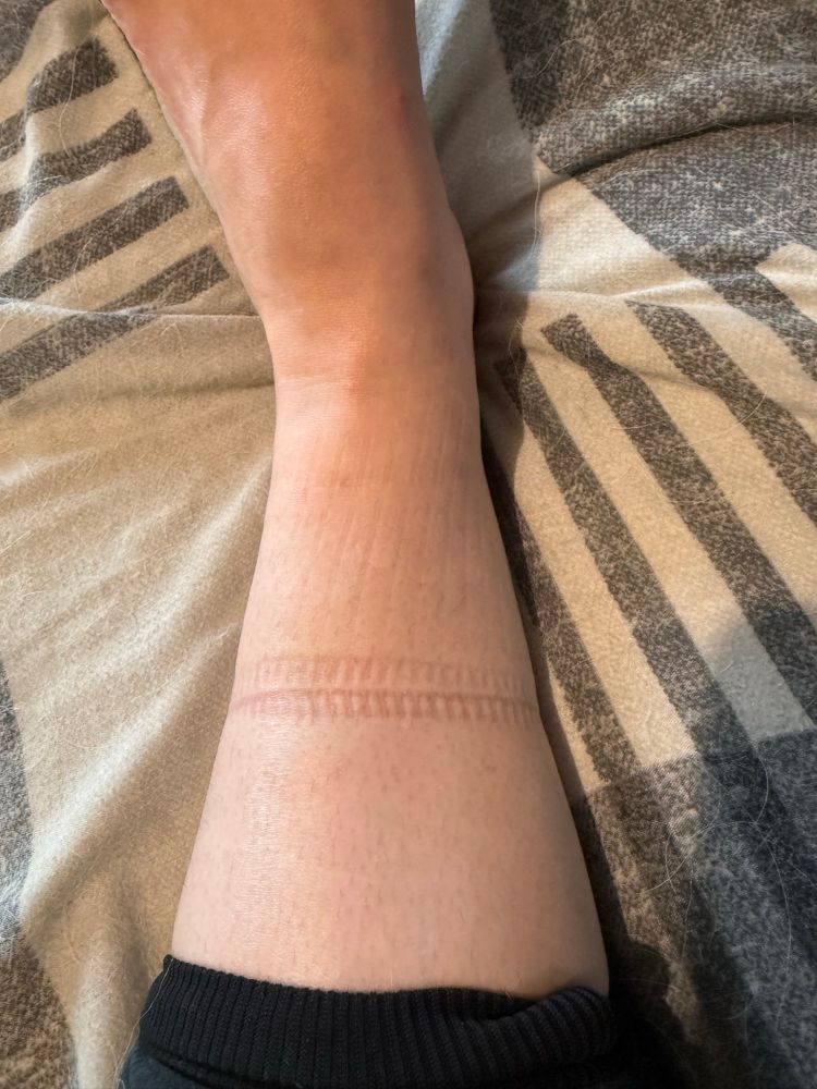 A photo of my leg where my socks and and it looks like a zipper is on my skin from the imprint of the sock