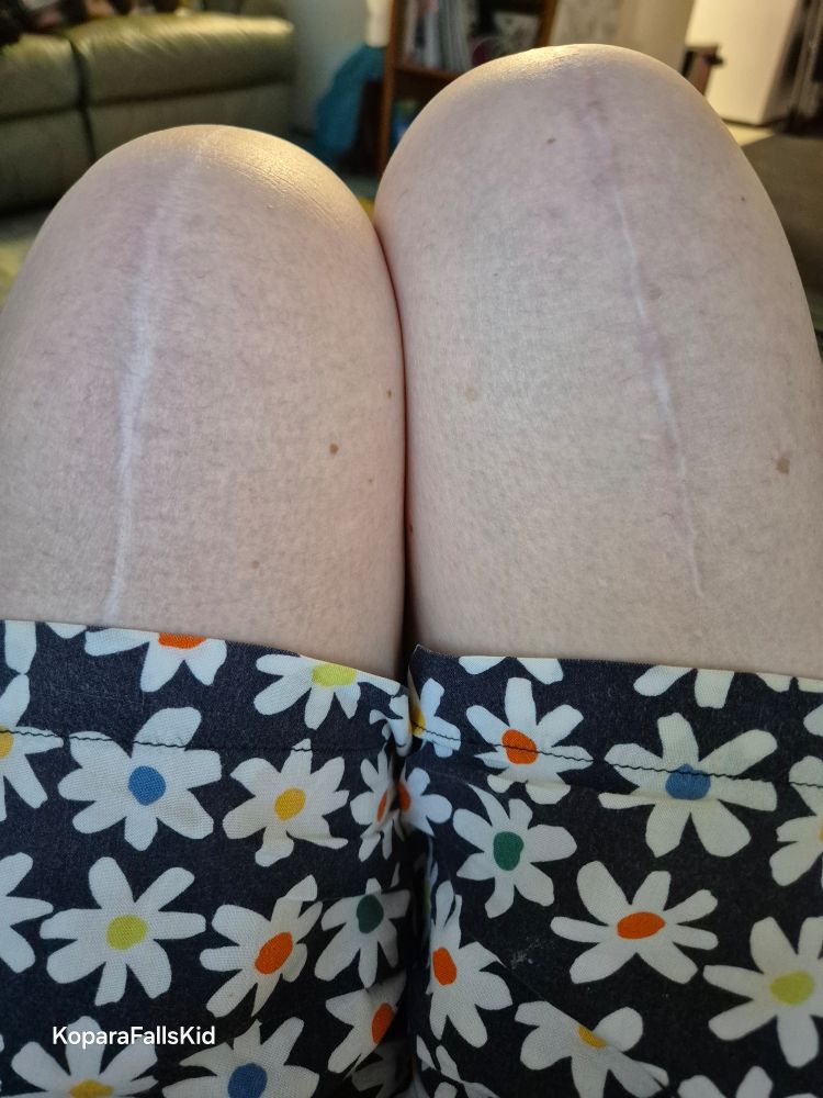 My knee scars