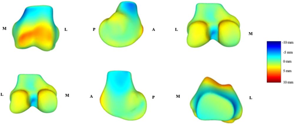 Point wise difference in surface geometry of the reconstructed femoral mode 3. Heat map indicates the extent of local anatomy variation in relation to increasing age.