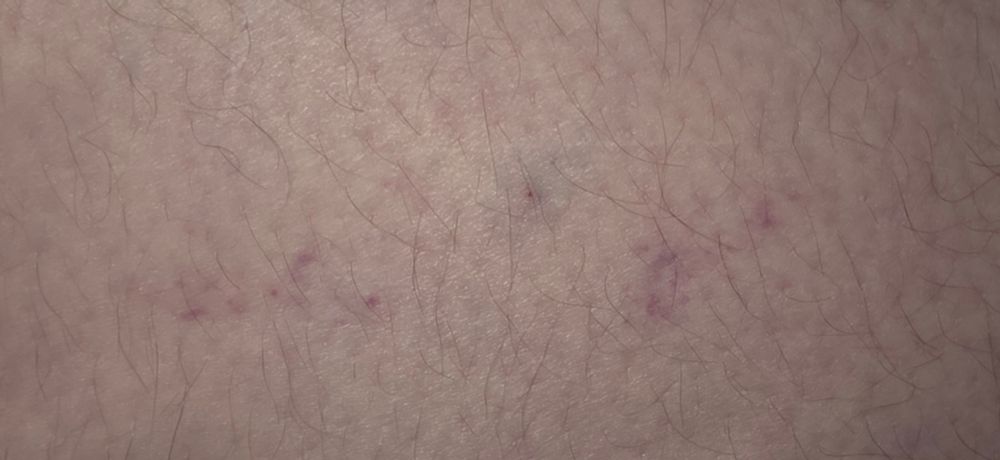 Bruises? On a leg