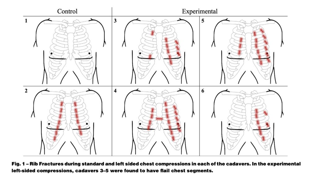 a figure demonstrating increased rib fractures in the left sided compression group compared to standard compressions. Of note, 3 out of 4 cadavers in left compression group developed flail chest segments (2 rib fractures per rib in at least 3 adjacent ribs).