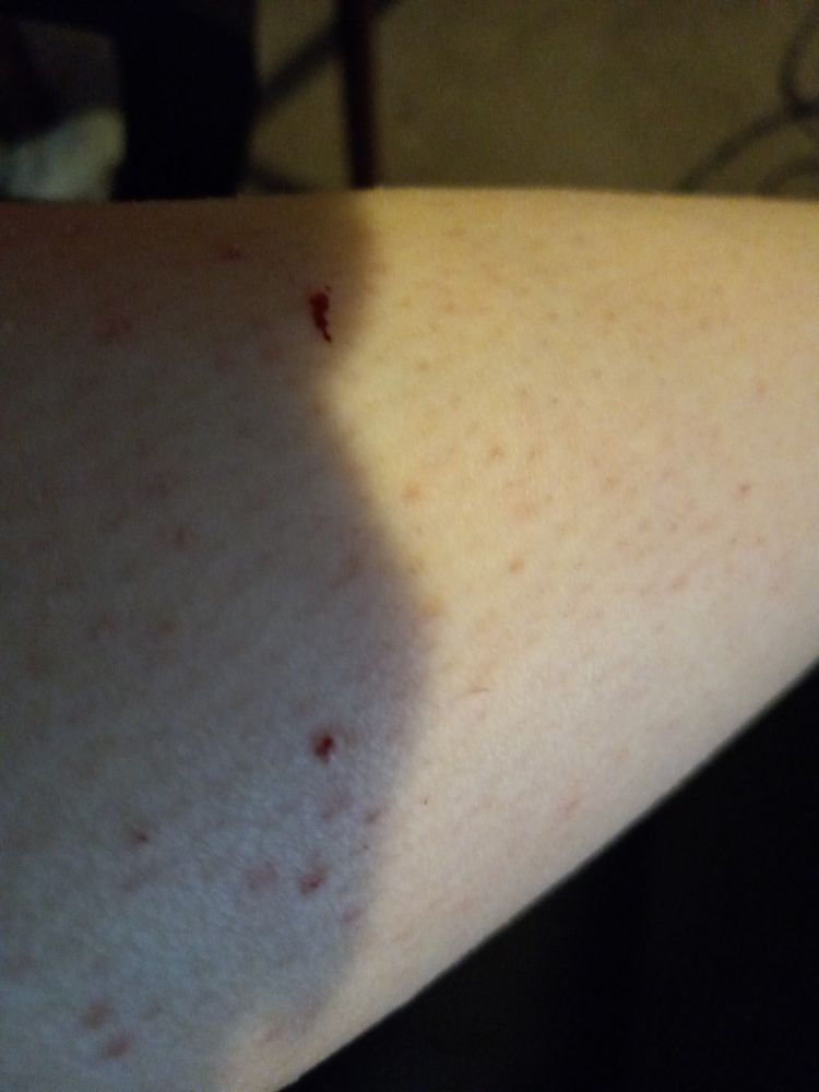 A photo showing my leg with a pair of small bloody cuts on them.