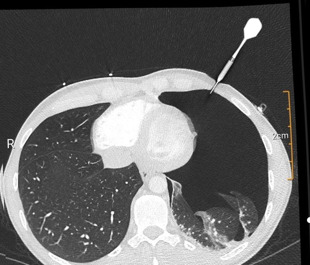 CT eines oberkörpers, der rechte lungenflügel ist da, erkenntlich durch feines weißes gewebe, der linke fast garnicht. im brustkorb steckt ein dartpfeil (der ist allerdings photoshop)