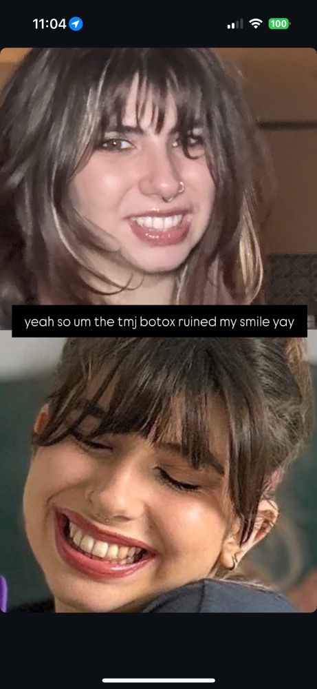 on top is a picture of estelle smiling but their smile isn’t wide so it looks a lot like a grimace. underneath is it a picture of estelle pre botox where we see their smile is much wide and the corners of her mouth actually lift up. in the top pic her top lip is also much less visible. there’s text saying “yeah so um the tmj botox ruined my smile yay” in between the pics