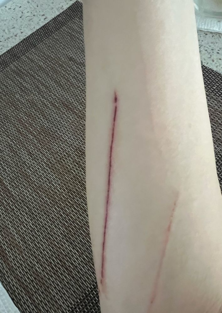 Forearm with 3 scratches from the person’s cat (NOT self harm)