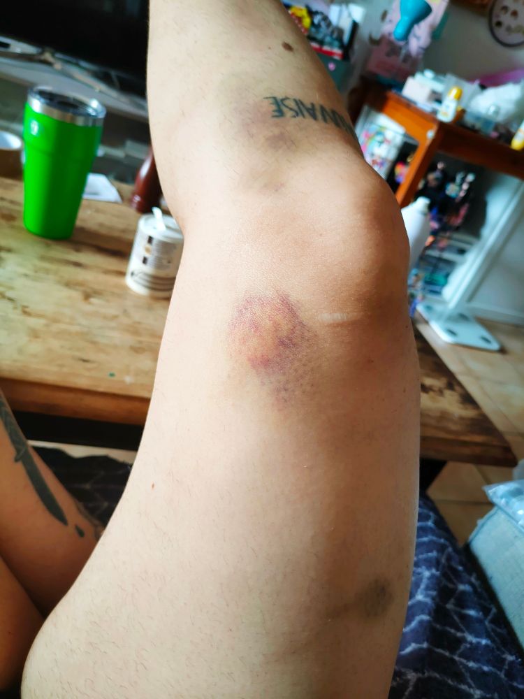Ma jambe en l'air. J'ai un bleu géant en dessous du genoux, un au-dessus du genoux et un au milieu de la cuisse