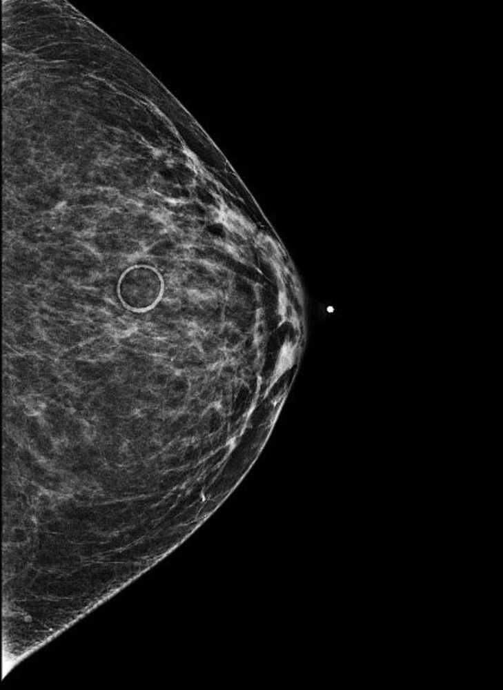 Mammogram image of the side profile of the breast of a middle aged transgender woman.