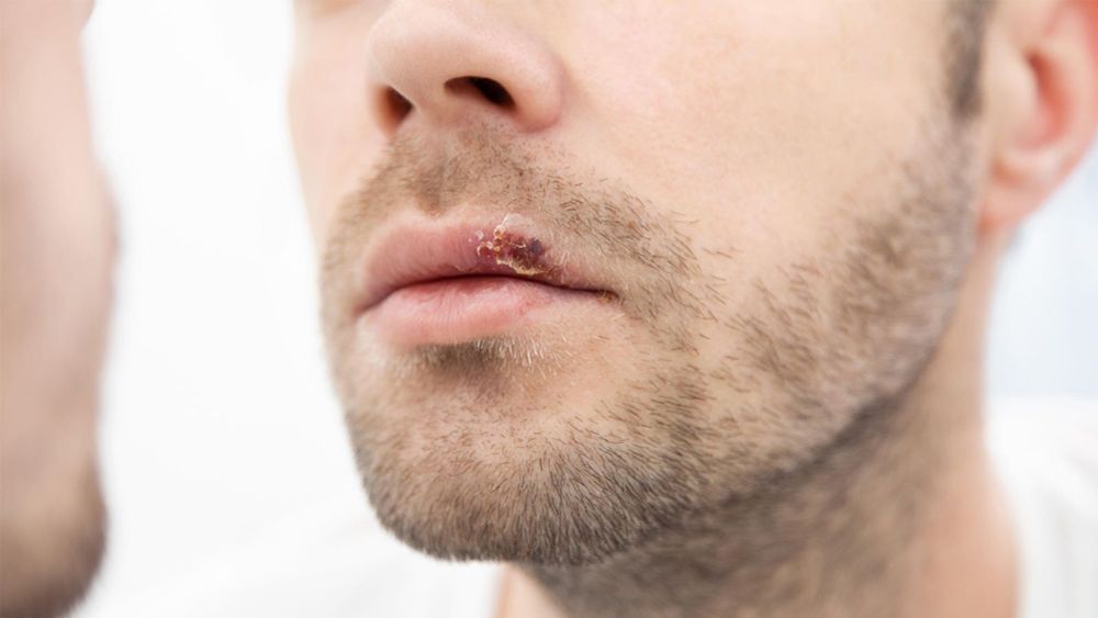 We cannot ignore the health consequences and shame faced by people with herpes