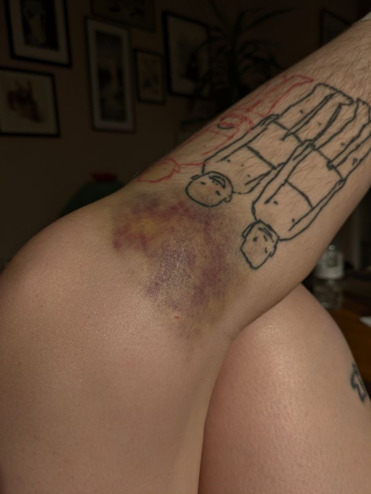 my knee, covered in a large, multicolored bruise