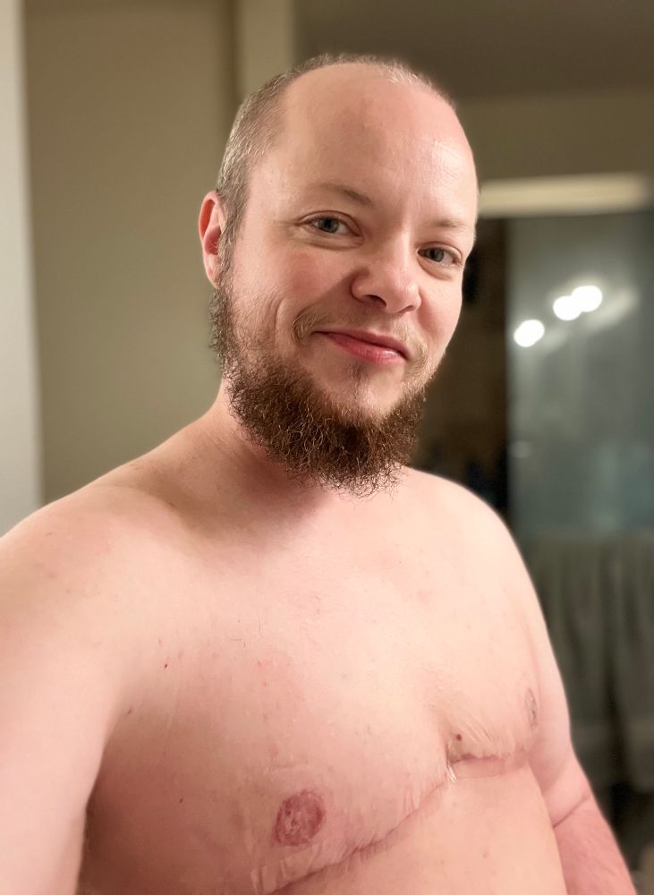 A shirtless selfie showing my 4-week-old top surgery scars. Things are healing pretty well, but the scars are still a dark pink which will eventually fade. 