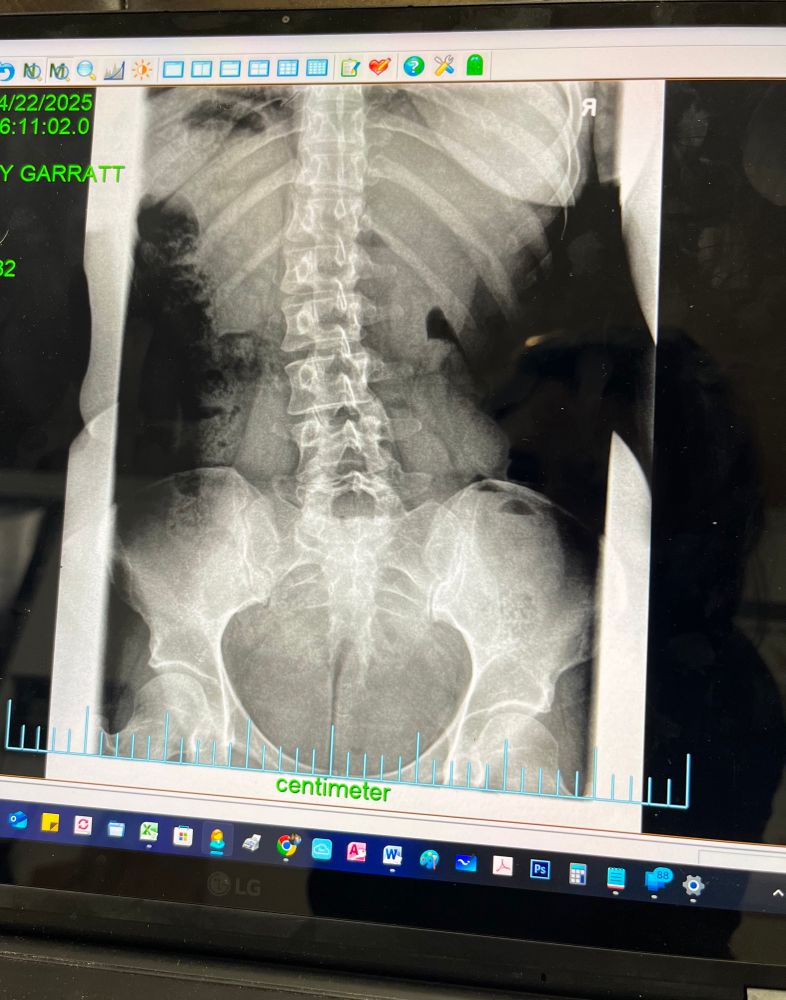 My spine with massive fucking scoliosis, like holy shit, no wonder I’m in pain always 