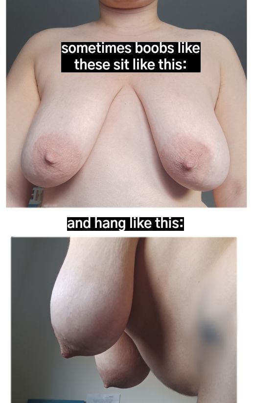Two photographs of my light-skinned chest with big breasts and big, light areolas. The upper is me facing forward and the bottom photo is taken from the side with me bending forward, with the text: "sometimes boobs like these sit like this ... and hang like this"