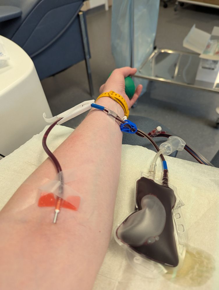 Avant-bras de donneuse de plaquettes. Aiguille dans le pli du bras + tubulure 