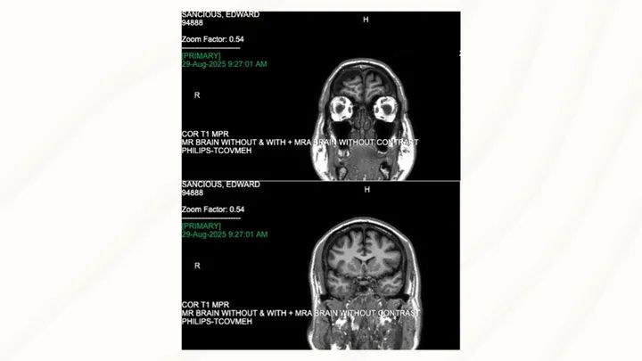 Photo of Ed's brain scan from his Go Fund Me page.