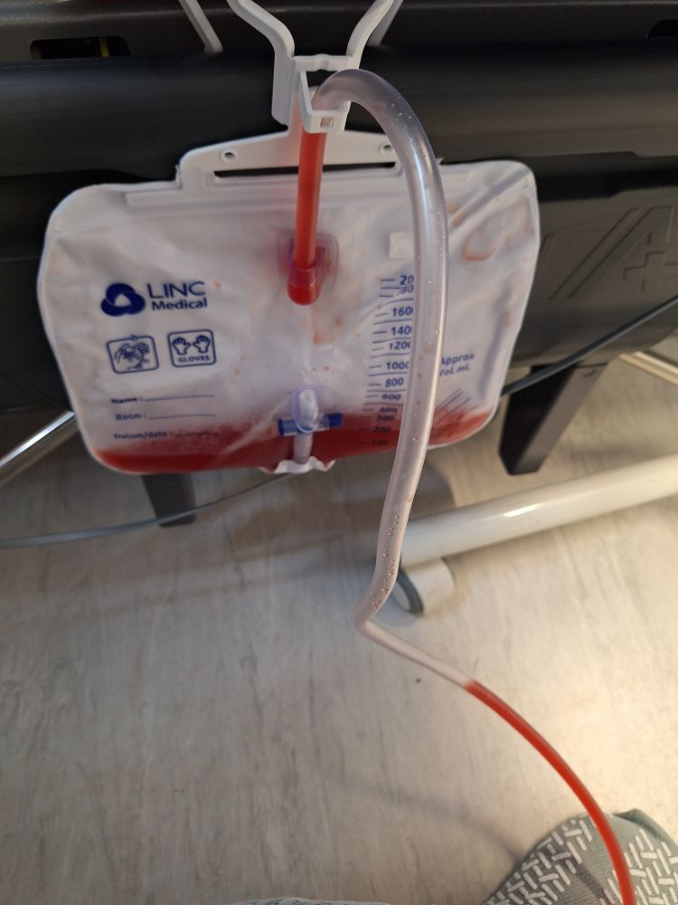 Urinary catheter bag with blood stained urine