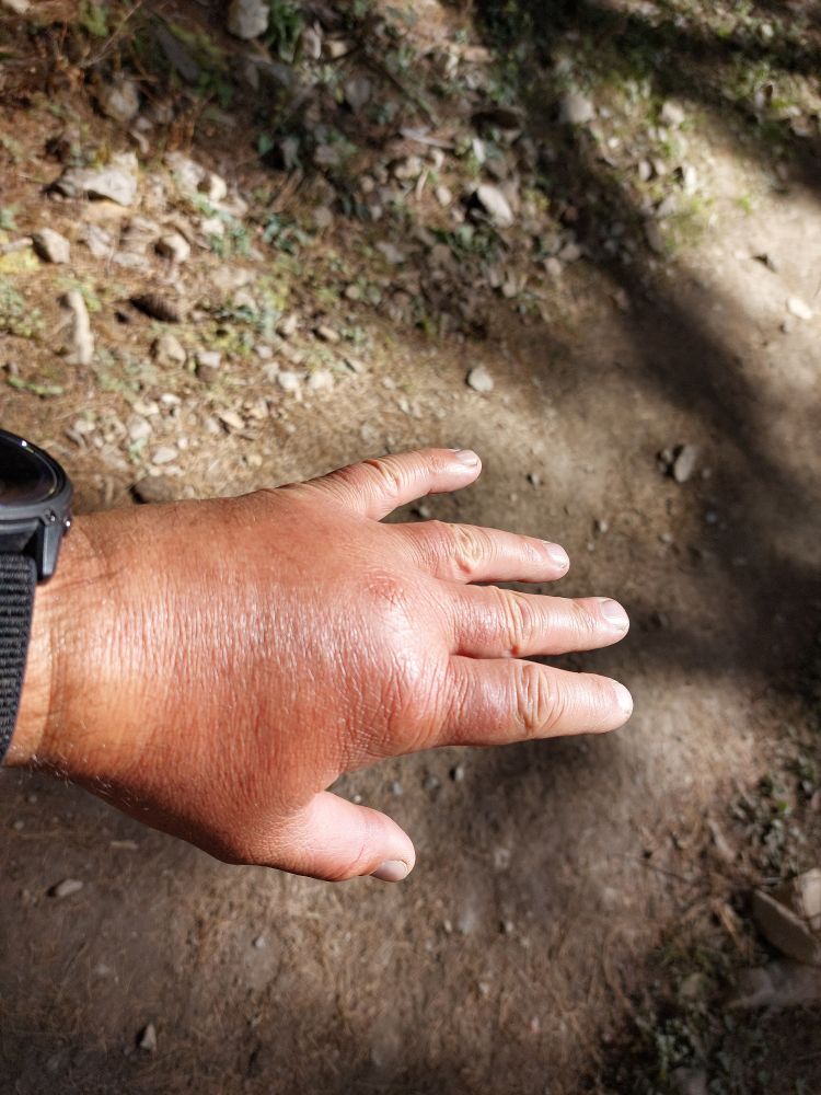 Gebrochene Hand