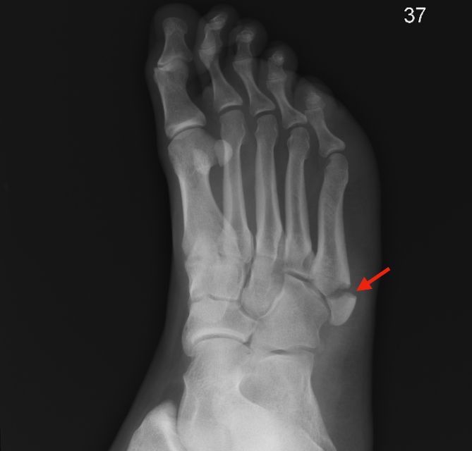 An x ray of a foot with a red arrow pointing to a break 