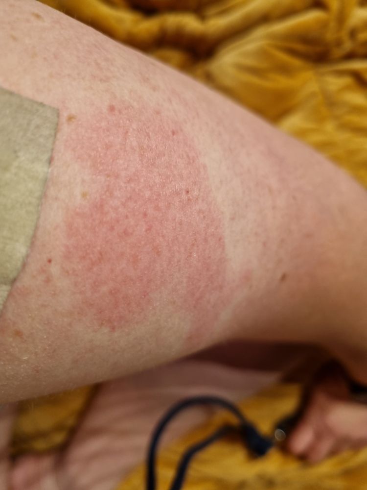 Oberarm mit Pflaster und rotem Fleck nach Impfung. Wird als herzförmig gesehen.