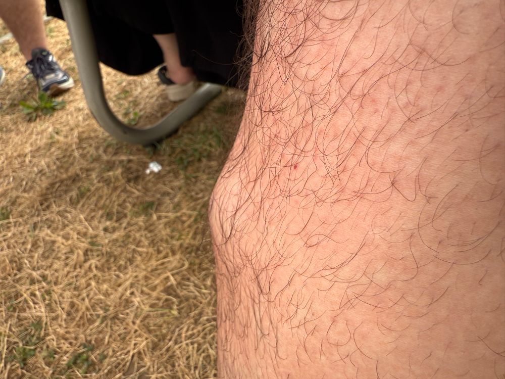 A lower leg with swelling.